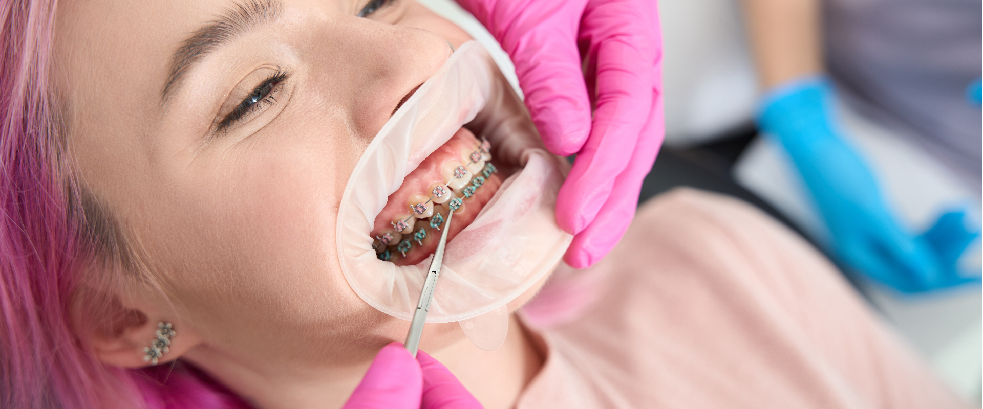 Braces Installation