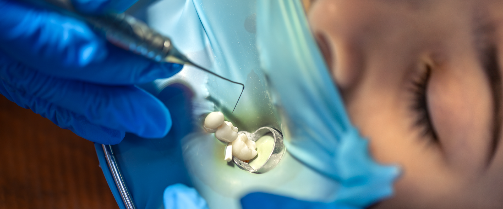 Tooth Extraction