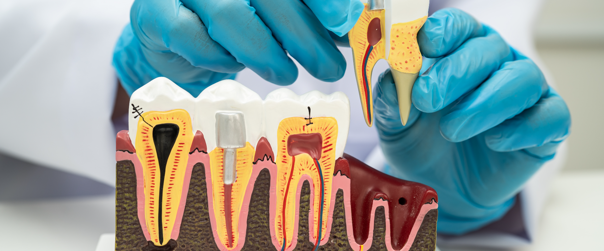 Root Canal